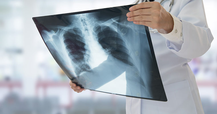 New Recommendations on Tuberculosis